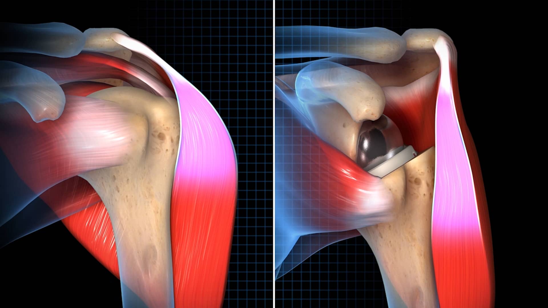 Exactech - Reverse Stemless Shoulder Arthroplasty